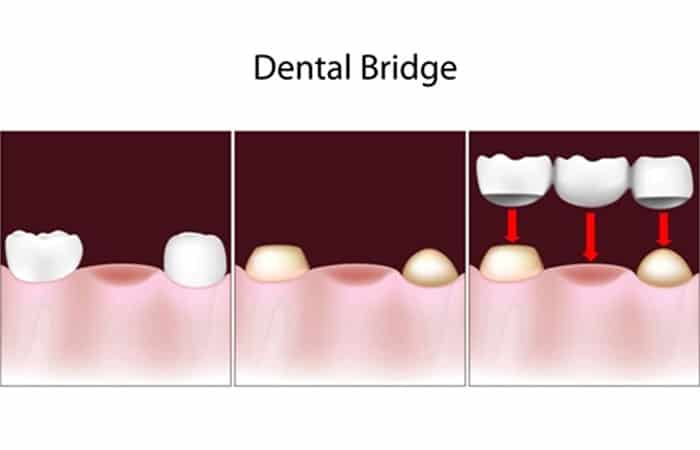 dental bridges in waterloo