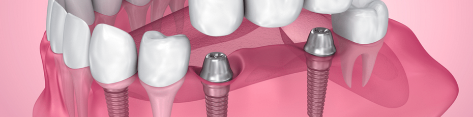 time to consider dental implants