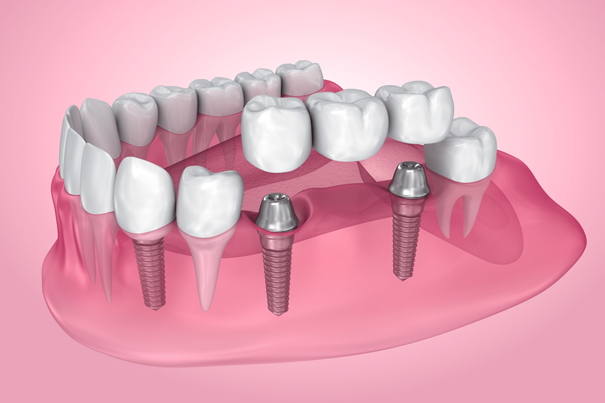 time to consider dental implants