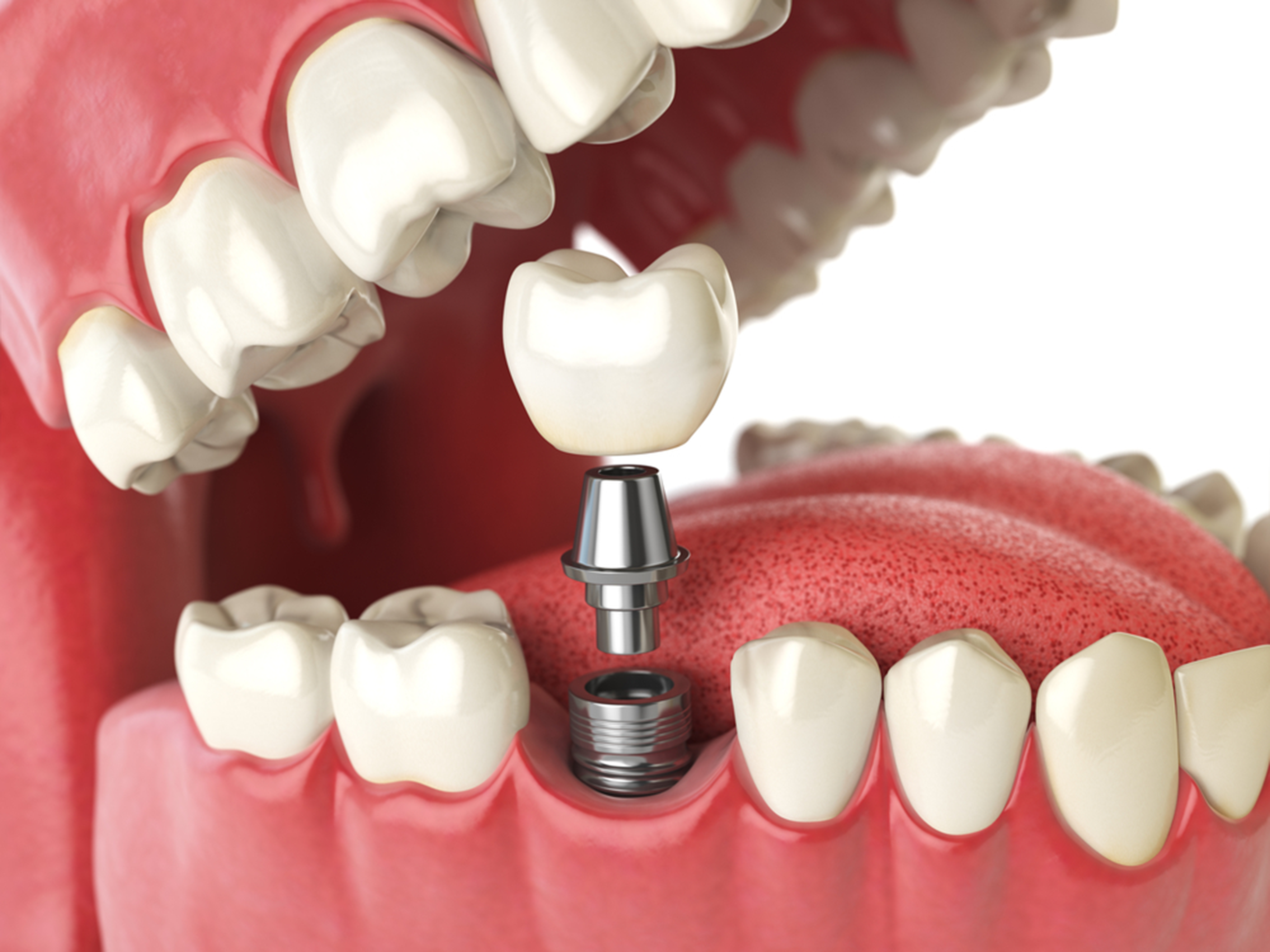 dental implants then and now