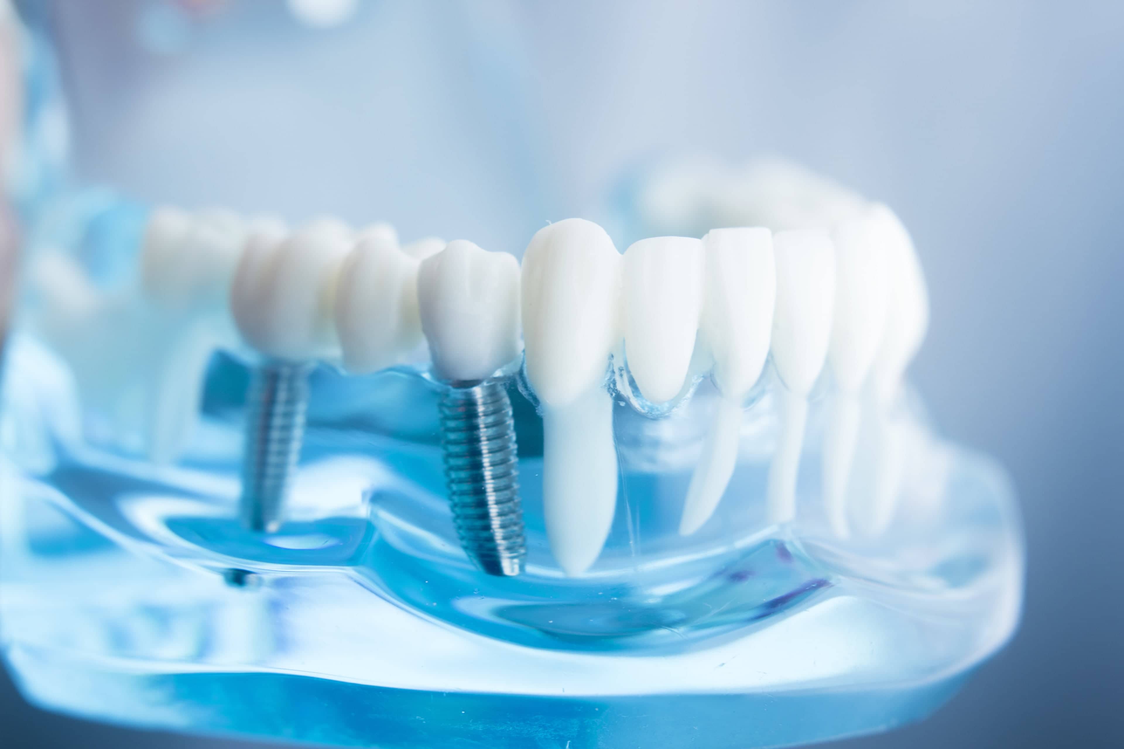 the steps to obtaining dental implants