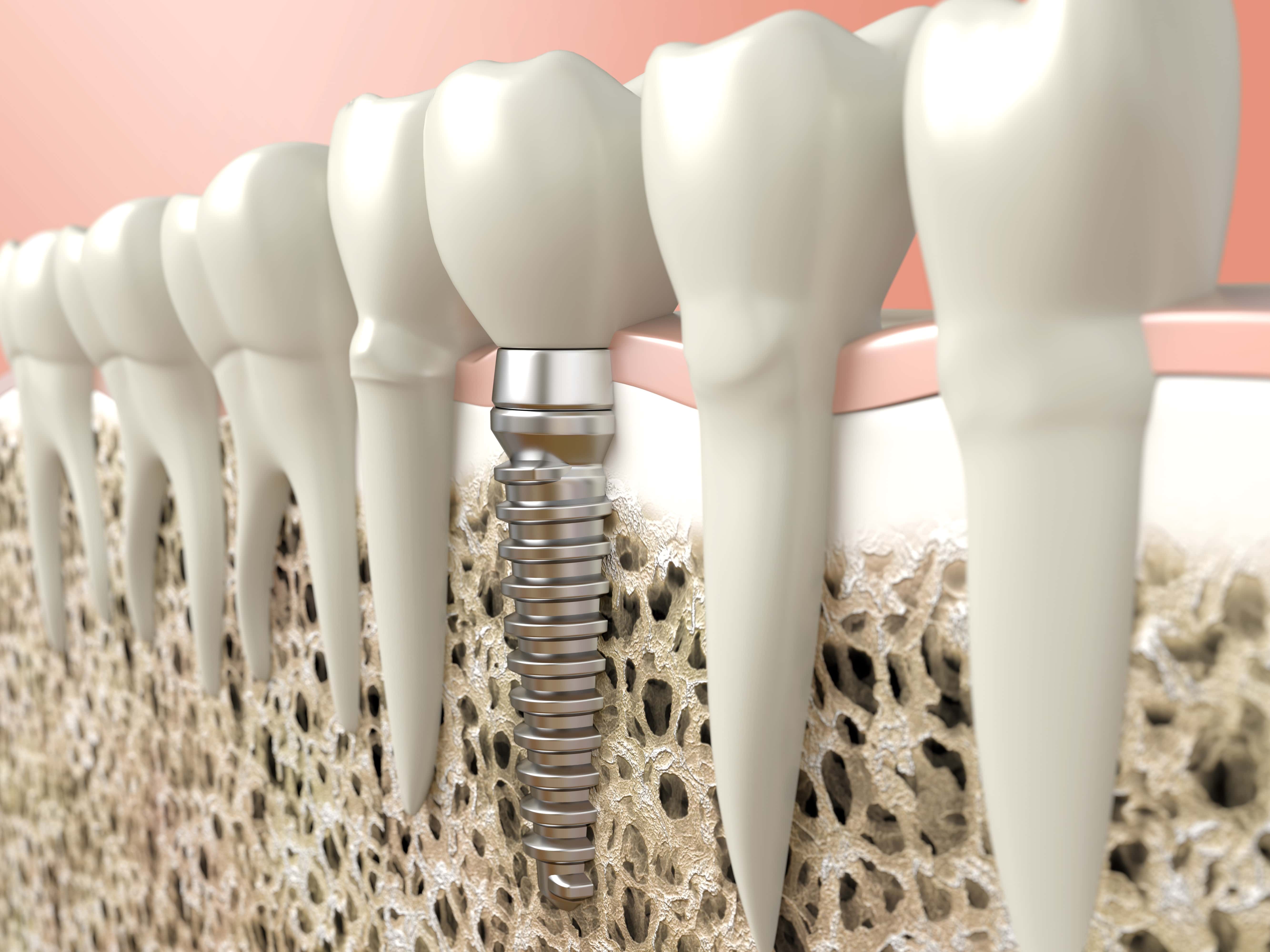 dental implants how long should they last