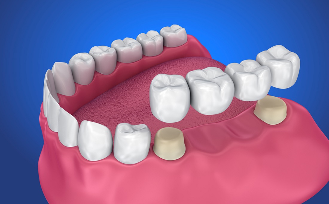 how do the dental bridges work