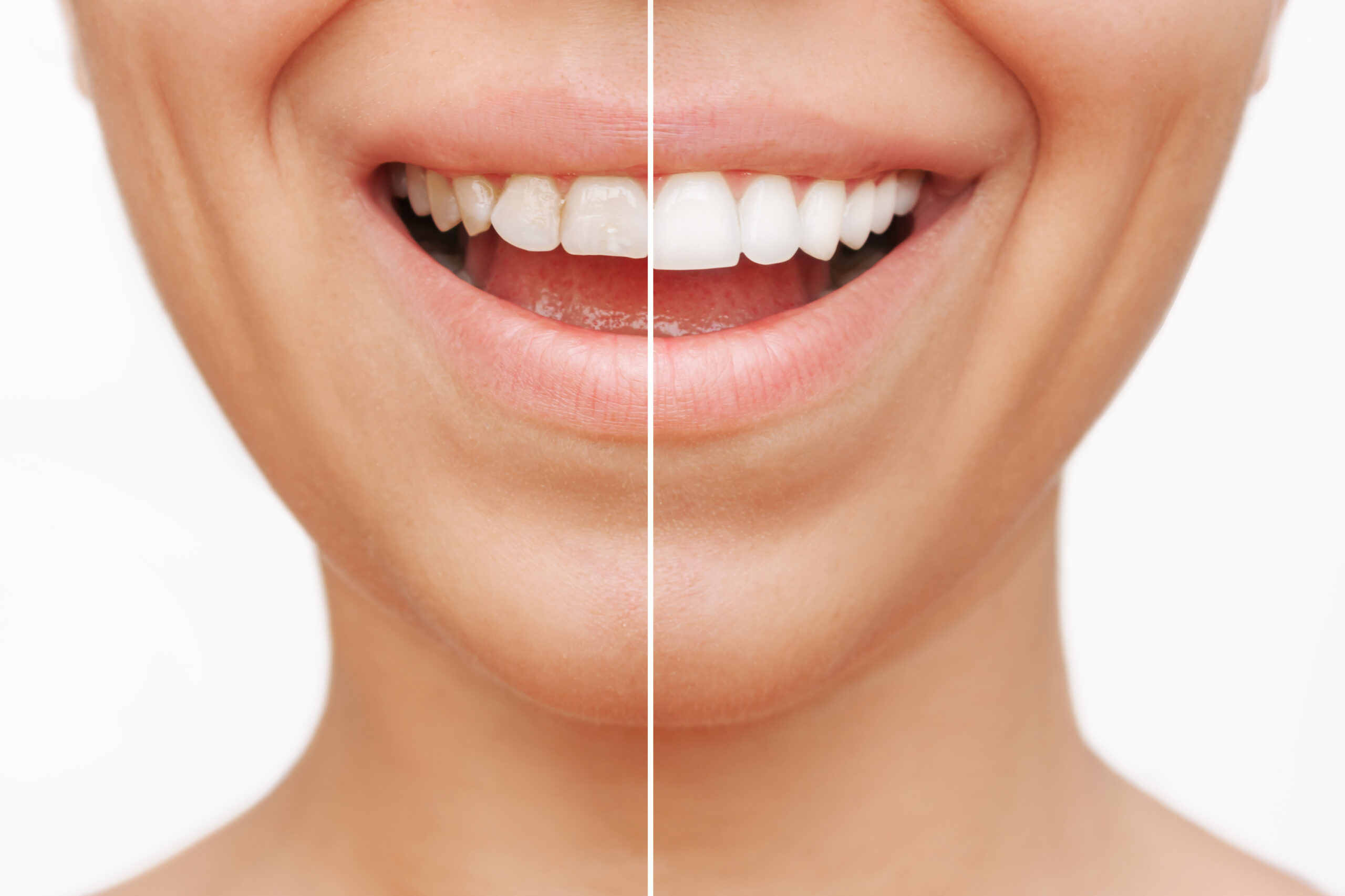 transforming your smile with veneers