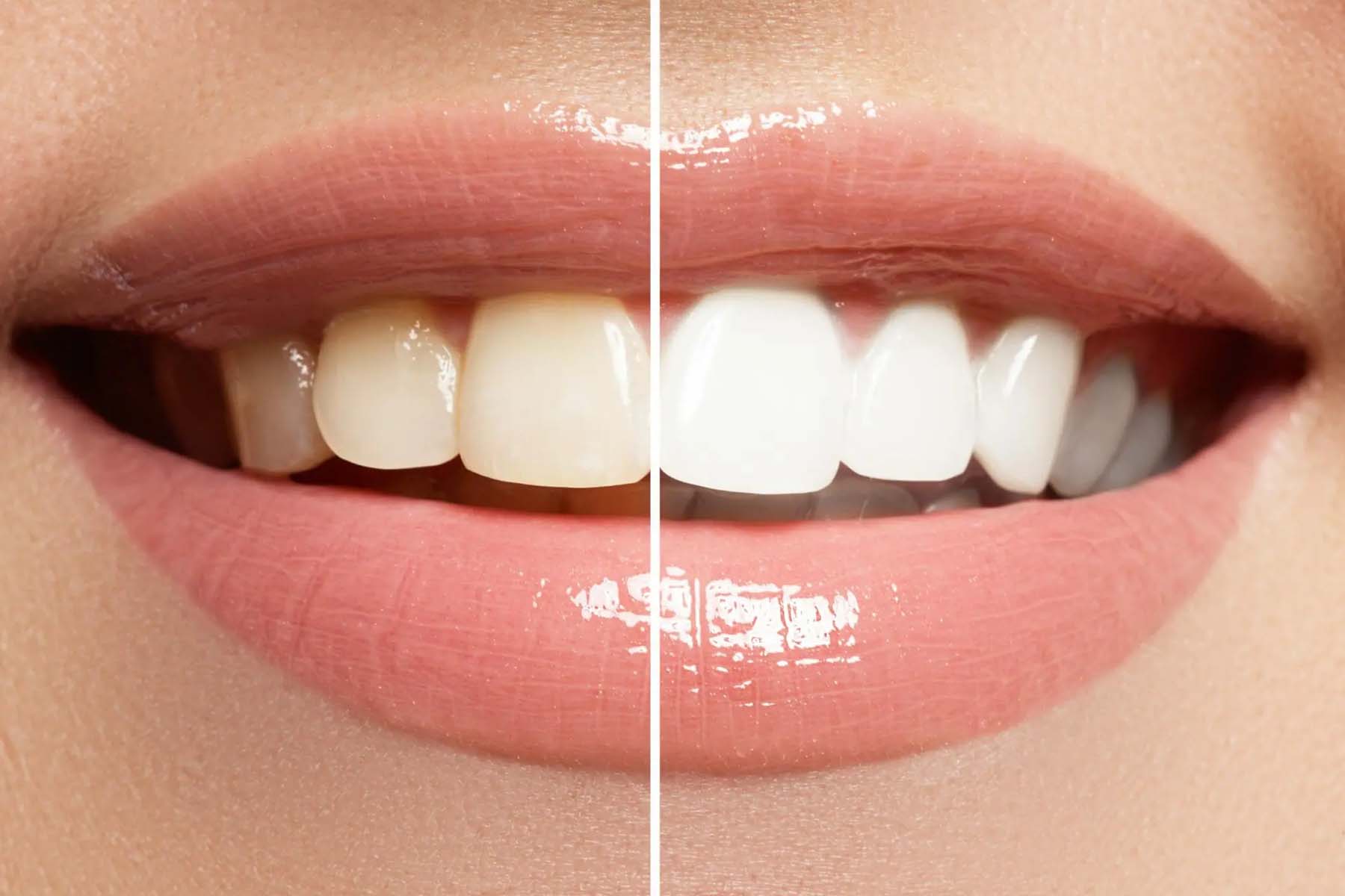 Benefits of Teeth Whitening