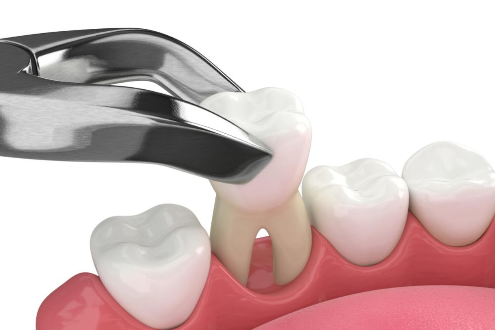 What should you not do before tooth extraction?