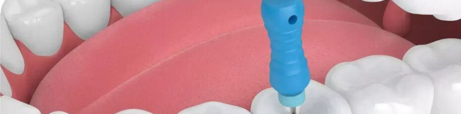 Root Canal Therapy: The Step-by-Step Process and What to Expect