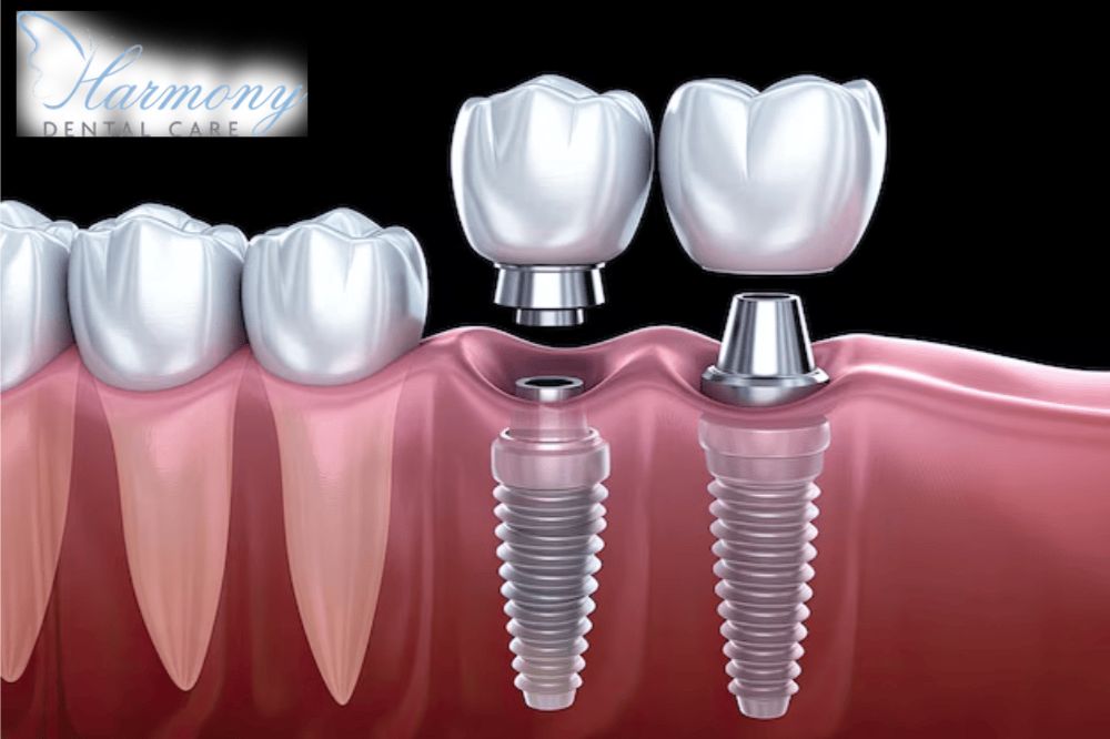Why Dental Implants Are the Best Solution for Missing Teeth