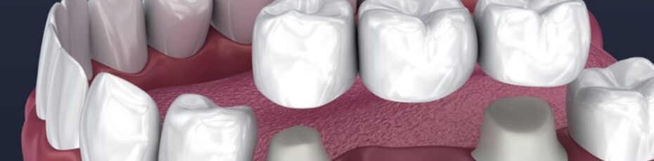 Dental Bridges in Waterloo
