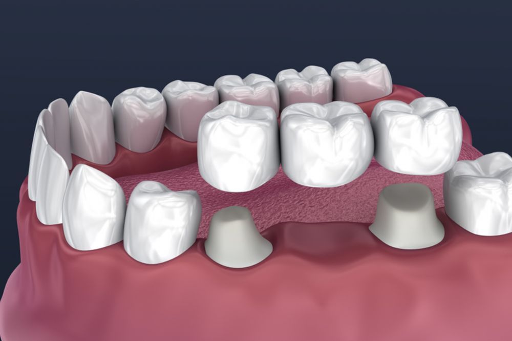 Dental Bridges in Waterloo