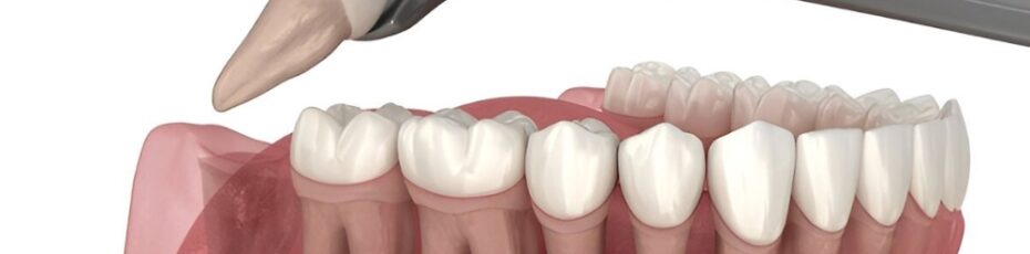 Dentist explaining wisdom teeth extraction process