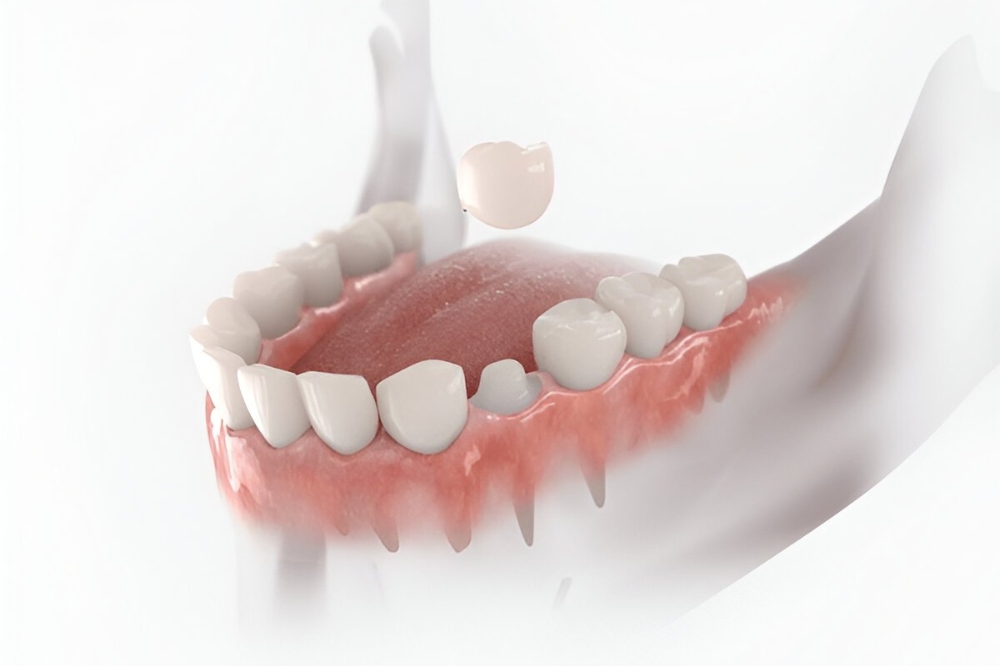 What Are Dental Crowns and How Do They Work?