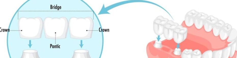 How Long Does a Dental Bridge Last? Lifespan, Care Tips, and When to Replace It