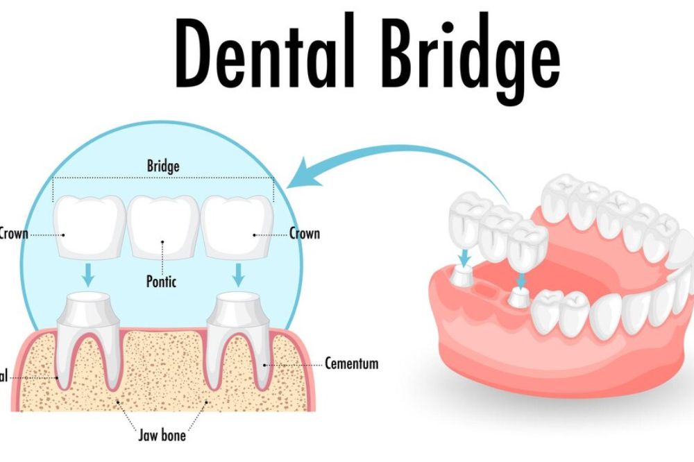 How Long Does a Dental Bridge Last? Lifespan, Care Tips, and When to Replace It