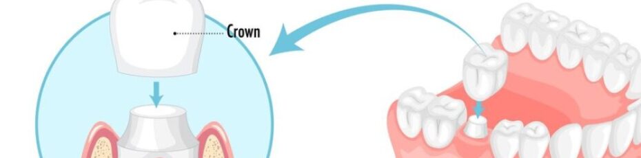 Crown vs. Filling: How to Know When Your Tooth Needs a Full Cap