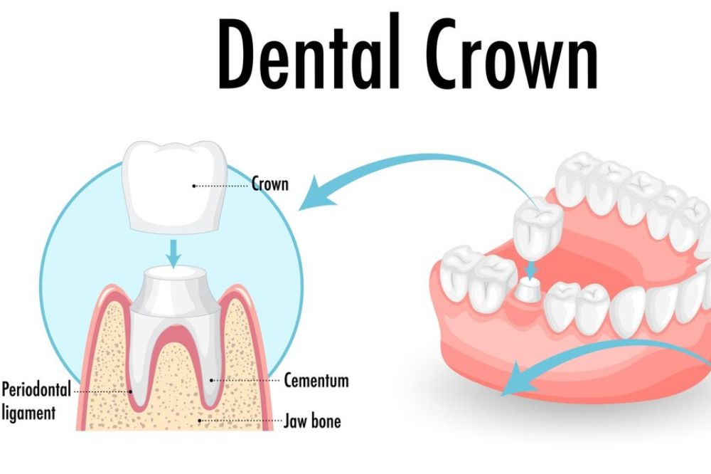Crown vs. Filling: How to Know When Your Tooth Needs a Full Cap