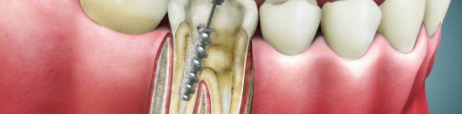How Long Does a Root Canal Last? Durability and How to Protect Your Restored Tooth