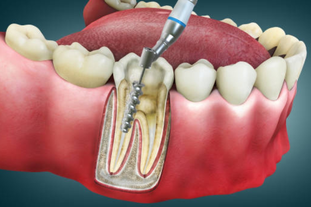 How Long Does a Root Canal Last? Durability and How to Protect Your Restored Tooth