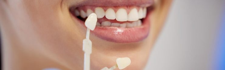 Why dental veneers are ideal for front teeth issues