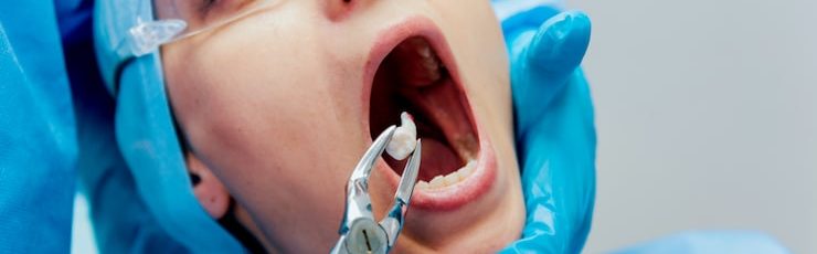 How a Dentist Diagnoses Impacted Wisdom Teeth Early